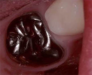 молочные зубы после лечения