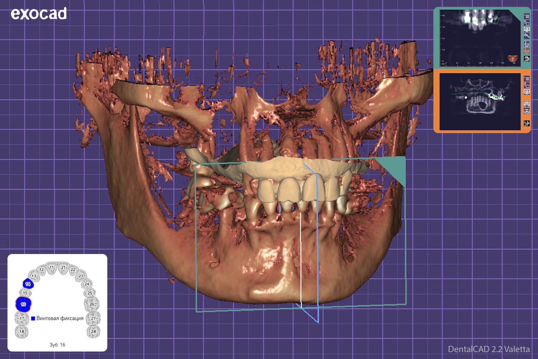 3D-моделирование виниров и имплантов