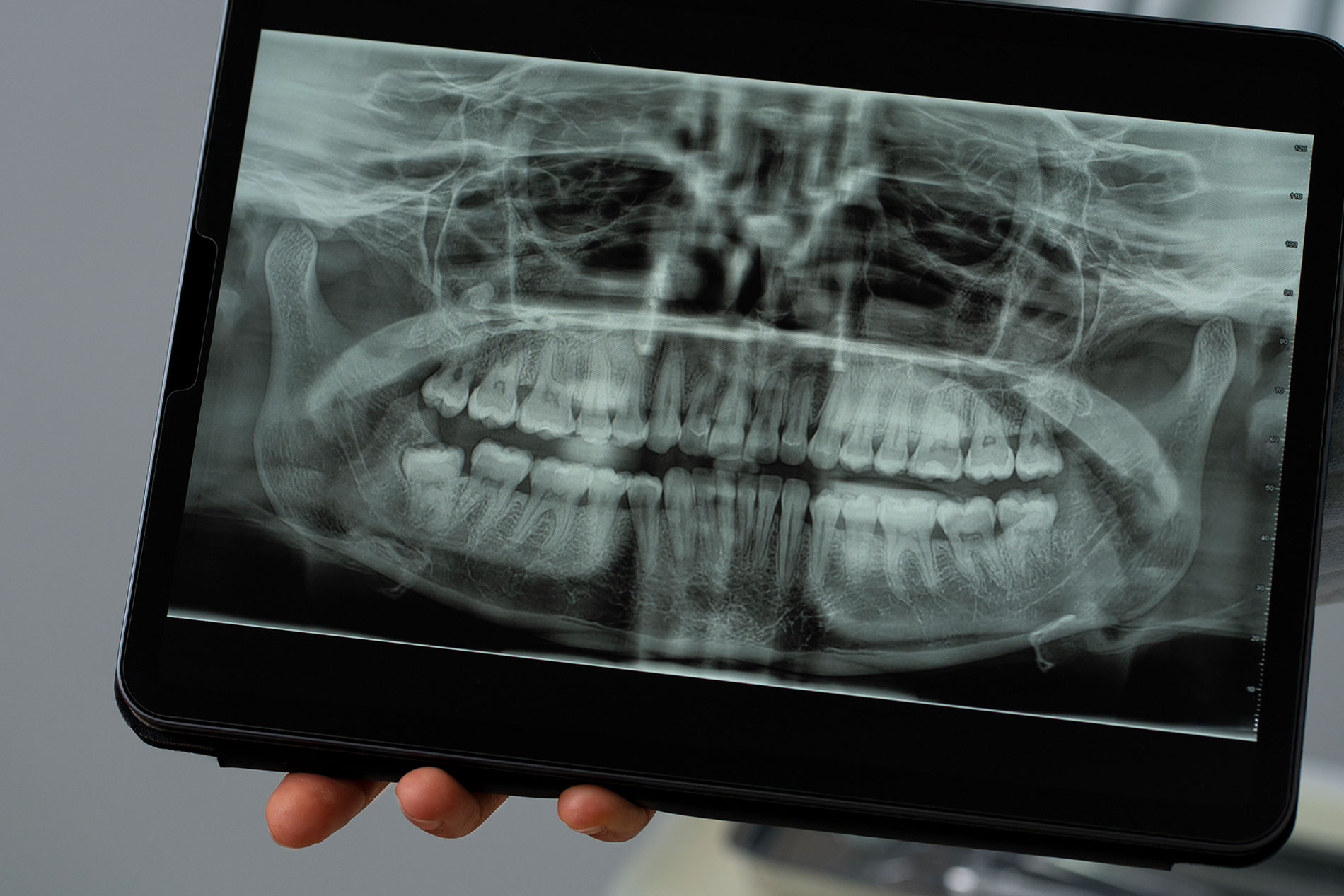 Рентгенография